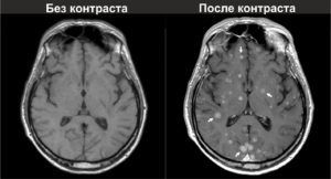 Как выглядит опухоль головного мозга на снимке МРТ